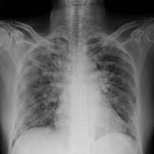 covid-19-lung-xray.jpeg